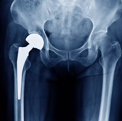 Hardware infections (prosthesis infection) can occur in prosthetics in the knee, hip, back, breast & anywhere in the body. Encompass Healthcare treats them all!