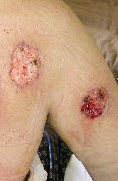 We treat pyoderma gangrenosum Encompass Healthcare in West Bloomfield, MI